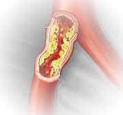 New Drug for Treatment of Atherosclerosis